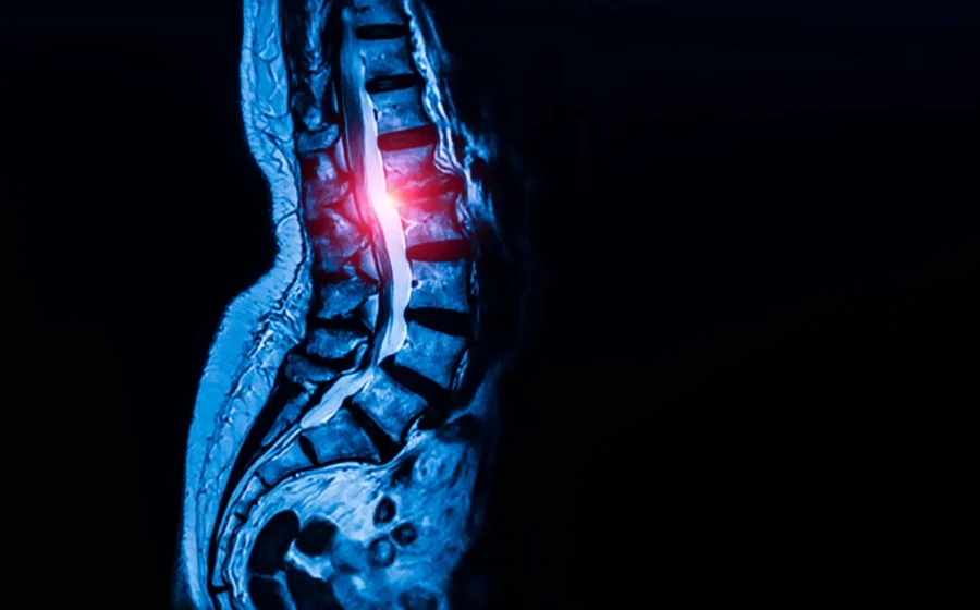 Hidden stem cells may be fueling spinal stenosis