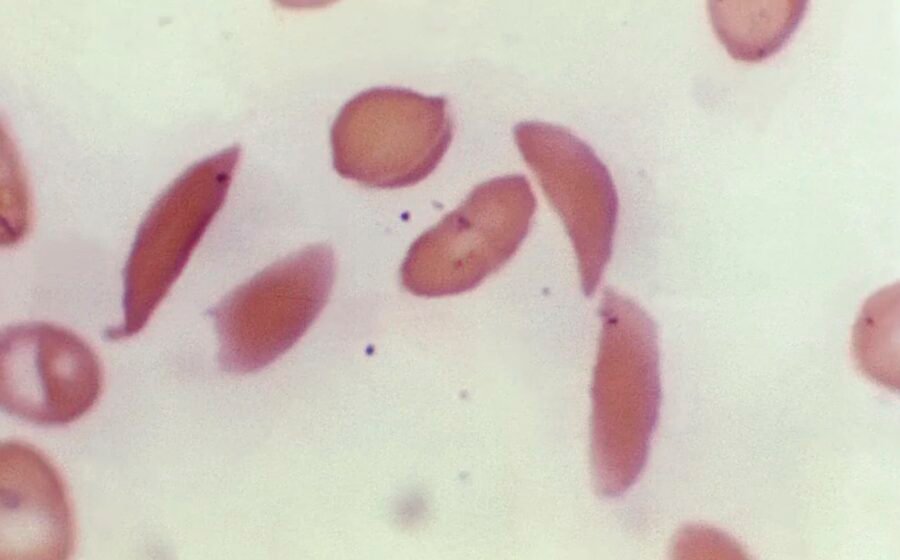 Sickle cell gene therapies offer new hope, but access remains a major challenge