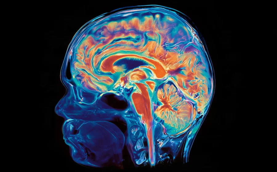 Rare study reveals a striking divide inside an Alzheimer’s patient’s brain
