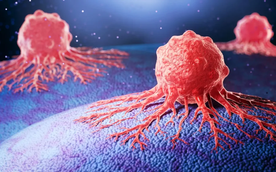 Cancer is rising in younger adults, and scientists can't fully explain why
