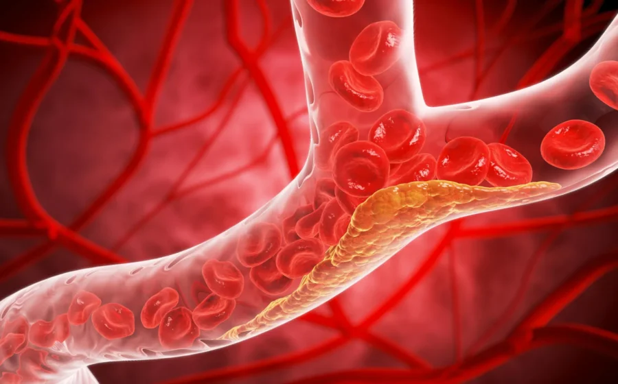 1 in 13 adults under 30 already had hidden artery plaque