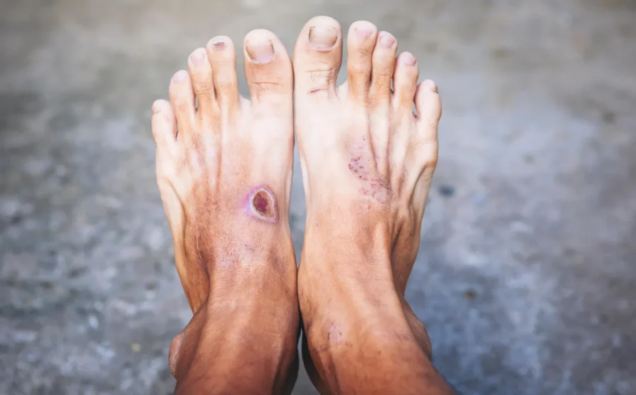 Scientists may have found why diabetic wounds refuse to heal