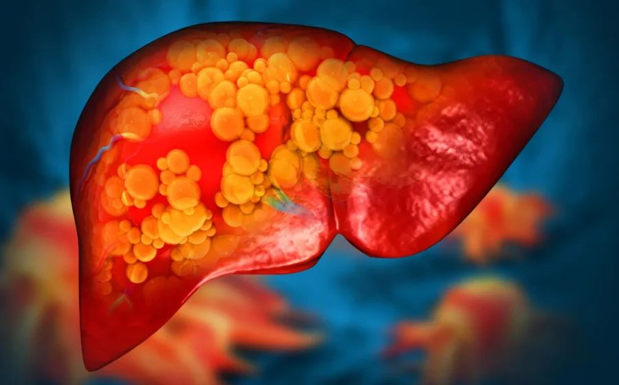 Eating late at night linked to up to 30% higher risk of liver disease